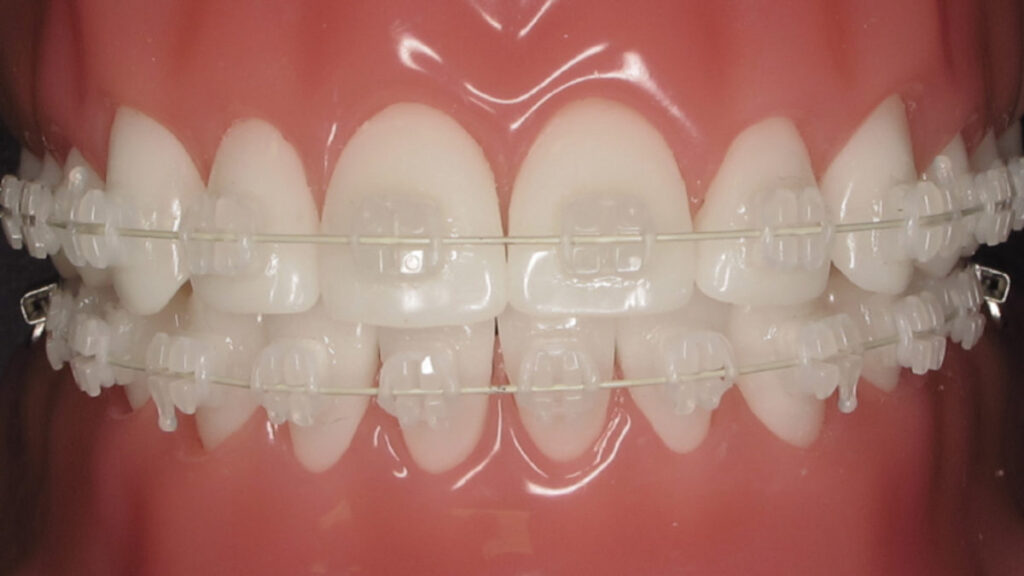 Dental ceramic braces | Finedent dental clinic