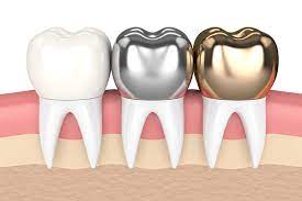 crowns | Finedent dental clinics