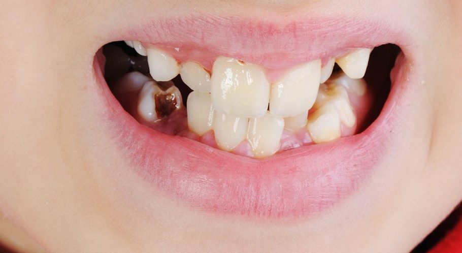 Discolored Teeth | Finedent dental clinics