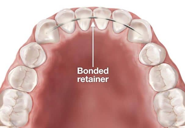 Dental fixed retainers | Finedent dental clinics