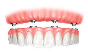 Implant-supported complete dentures | Finedent dental clinics
