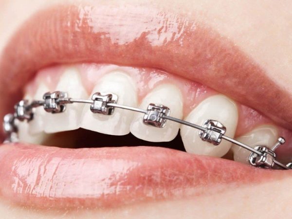 Metal braces | Finedent dental clinics