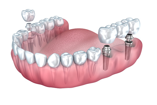 Multiple Tooth Replacement | Finedent dental clinics