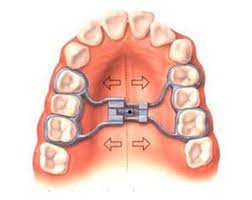 Rapid maxillary expansion | Finedent dental clinics