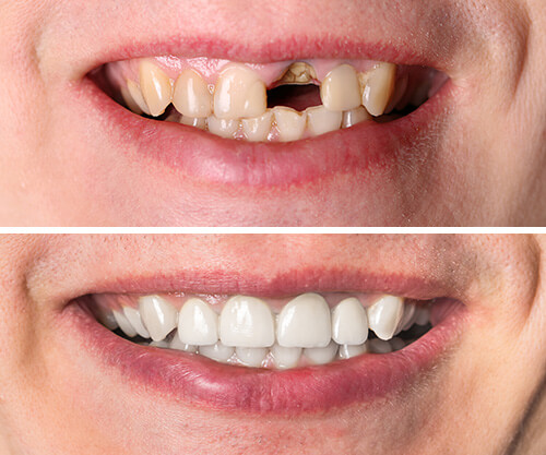 Dental restorations | Finedent dental clinics