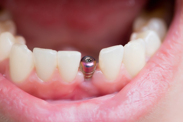 Single Tooth Replacement | Finedent dental clinics