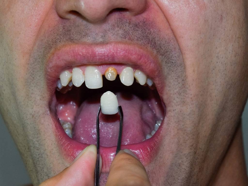 Dental veneers | Finedent dental clinics