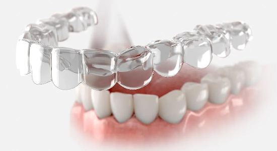 Invisalign aligners | Finedent dental clinics