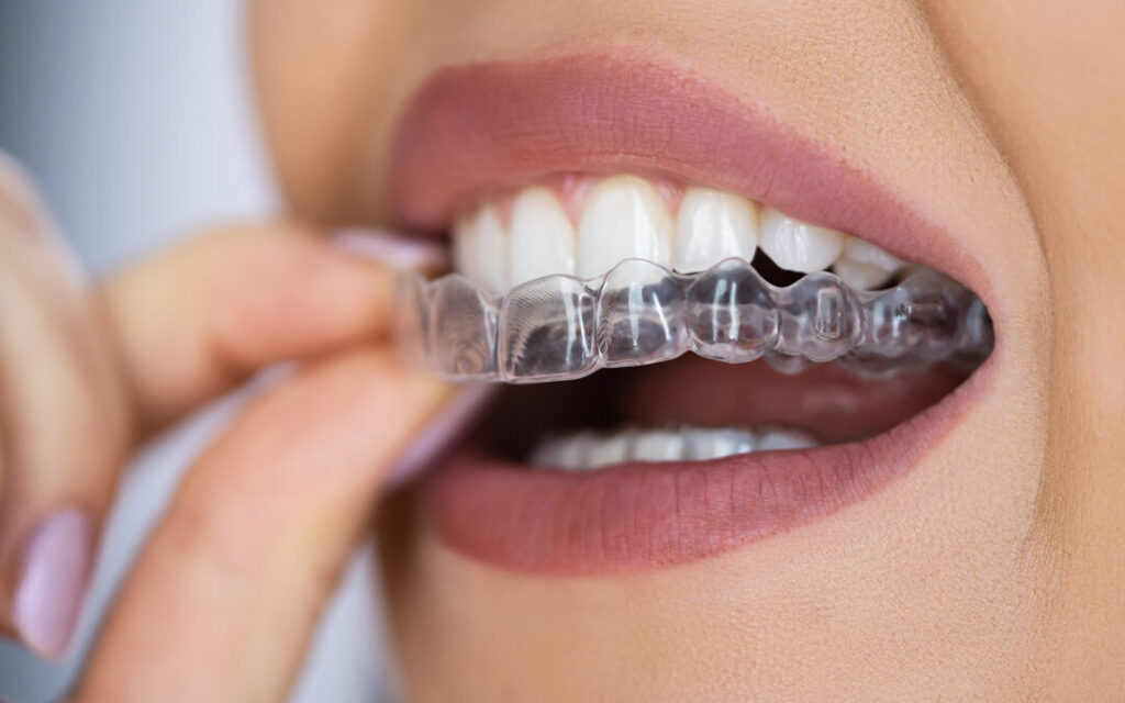 invisible braces | Finedent dental clinics