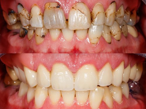 Full mouth rehabilitation | Finedent dental clinics