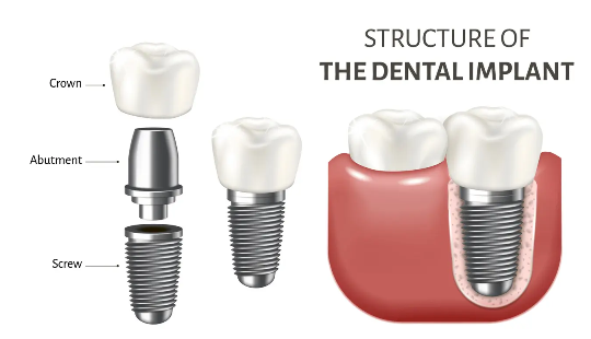 Structure of dental implants | Finedent dental clinics