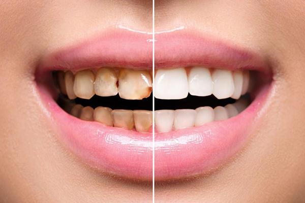 Dental laminates | Finedent dental clinics