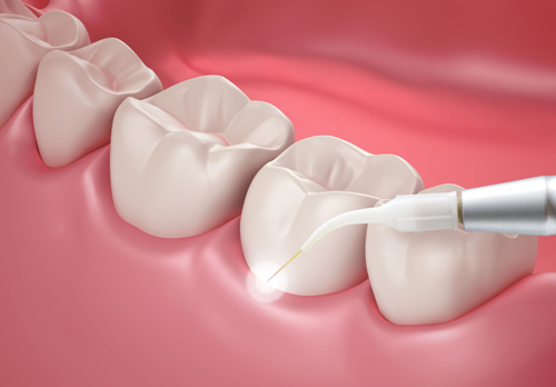 Crown Lengthening By Lasers | Finedent dental clinics