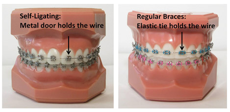Self-ligating Braces | Finedent dental clinics