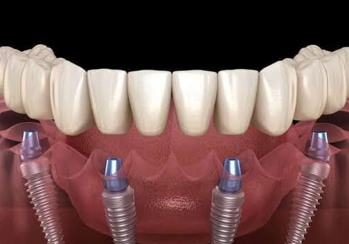 dental implants | Finedent dental clinics