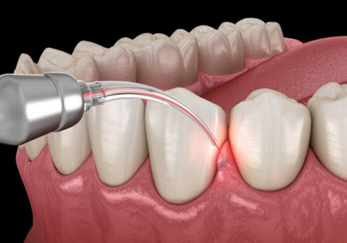 Crown Lengthening By LASERS | Finedent dental clinics