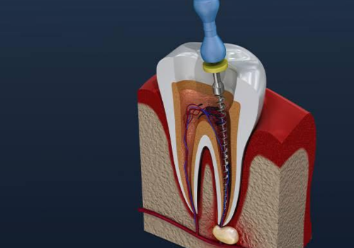 Root canal treatment | Finedent dental clinics