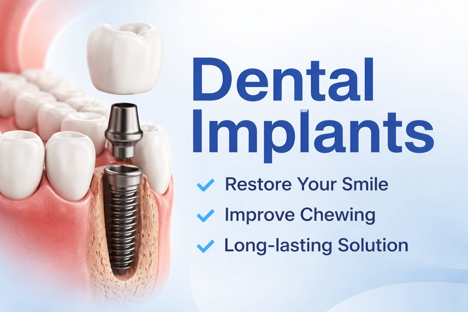 Dental Implants in Nanakramguda