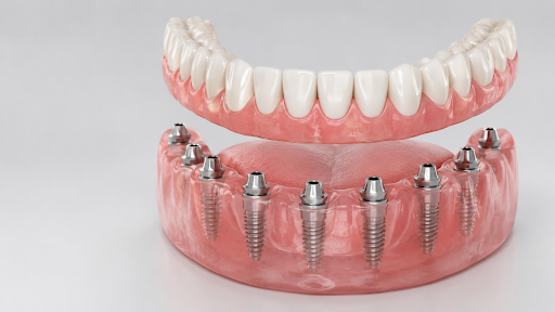Dental Implants in Nanakramguda 